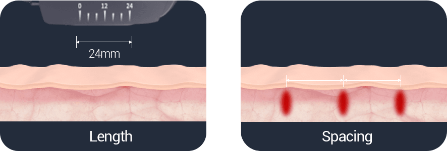 MICROSON HIFU — manufacturer image