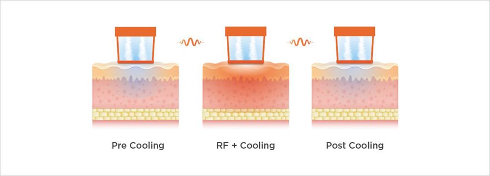 OLIGIO RF — manufacturer image